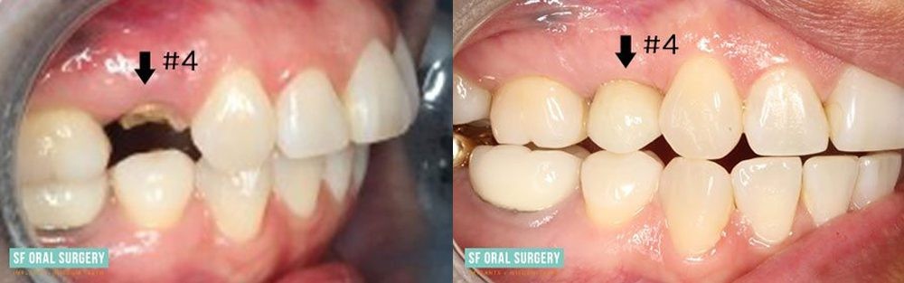 Dental Implants Before and After Tooth #4