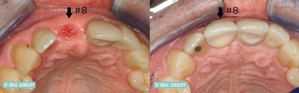 Dental Implants Before and After Tooth #8 View 2