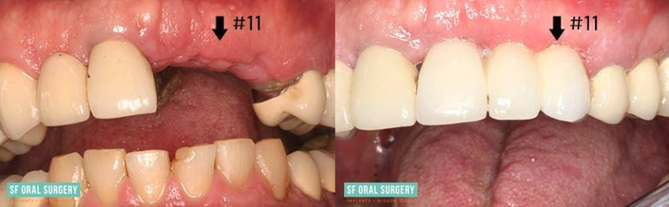 Dental implants before and after photo P12